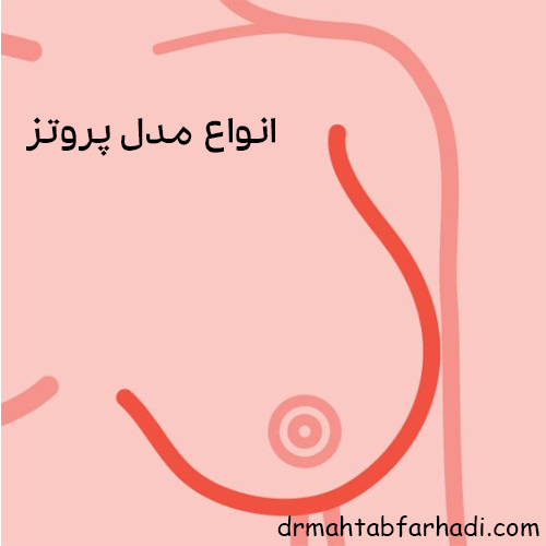 انواع مدل پروتز