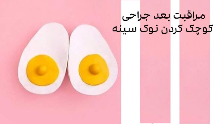 مراقبت بعد جراحی کوچک کردن نوک سینه