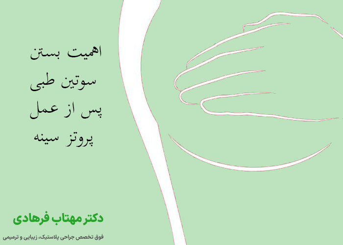 اهمیت بستن سوتین طبی پس از عمل پروتز سینه