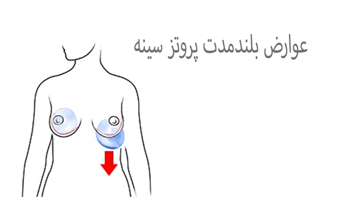عوارض بلندمدت پروتز سینه
