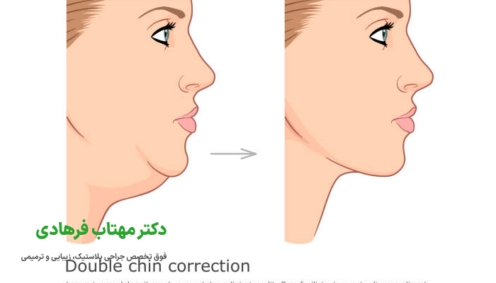ساکشن غبغب چیست؟