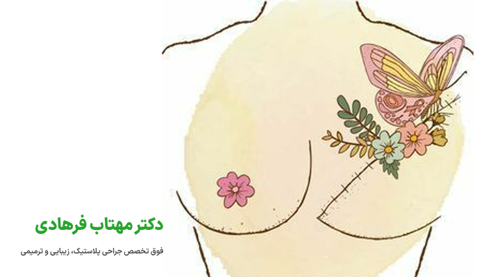 مدت زمان بهبودی و کاهش درد پس از جراحی پروتز سینه