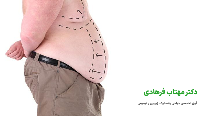 مزایا لیپوساکشن