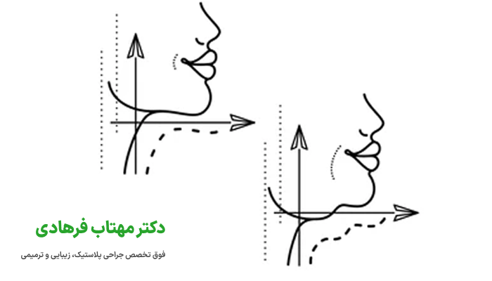 معایب و عوارض ساکشن غبغب