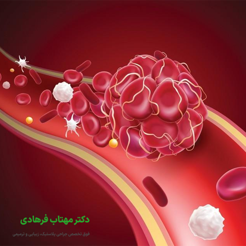 بعد لیپوماتیک احتمال آمبولی وجود دارد؟