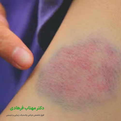 علت آمبولی بعد از عمل
