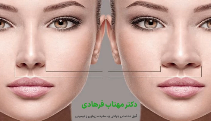 عوامل مؤثر بر بزرگ به نظر رسیدن بینی گوشتی بعد از عمل