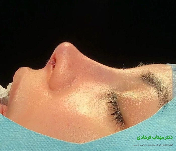 نحوه انجام جراحی بینی استخوانی