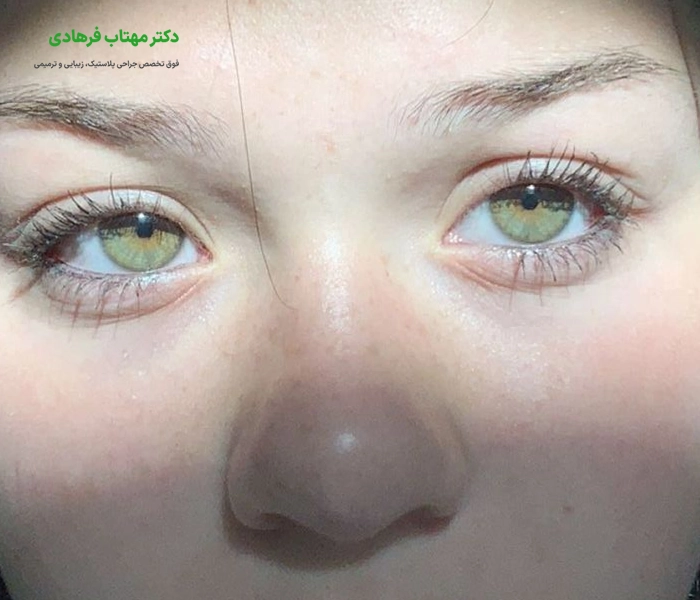 اقدامات قبل از جراحی بینی گوشتی
