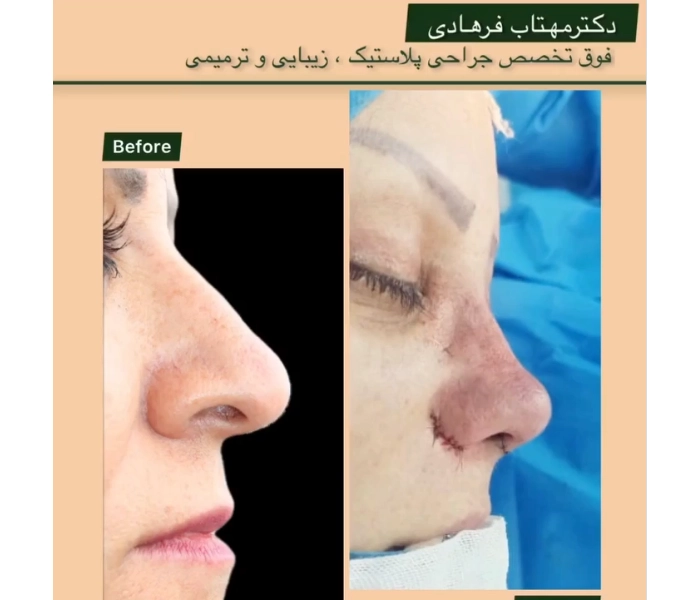 عمل بینی