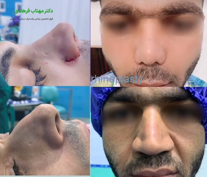 نمونه عمل بینی دکتر فرهادی