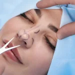 حداکثر سن عمل بینی