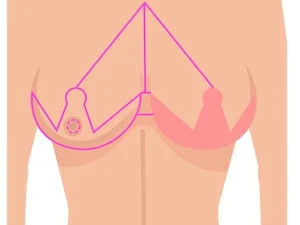 تفاوت بین ماموپلاستی افزایش و کاهشی
