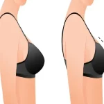 ماموپلاستی در نوجوانان