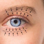 مدت زمان بهبودی بعد از بلفاروپلاستی