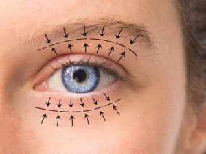 مدت زمان بهبودی بعد از بلفاروپلاستی