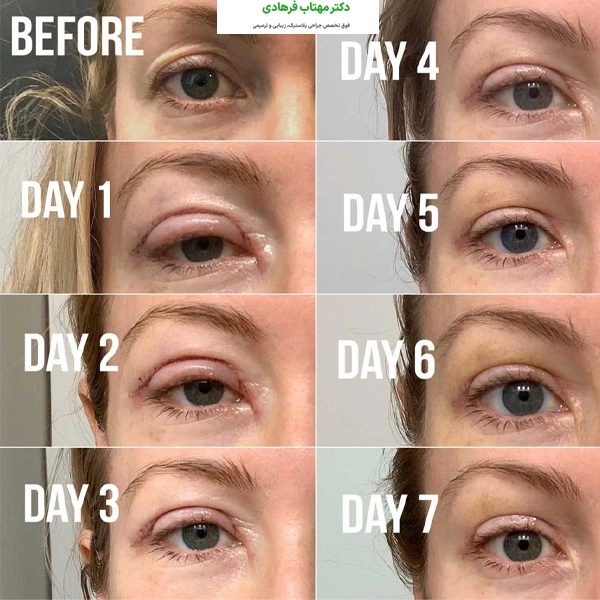 مدت زمان کلی بهبودی بعد از بلفاروپلاستی