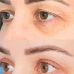 مراقبت‌های بعد از بلفاروپلاستی