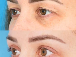 مراقبت‌های بعد از بلفاروپلاستی