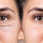 ماندگاری نتایج بلفاروپلاستی